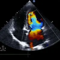 Heart Ultrasound Determines Dementia Risk