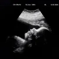 Unlocking the Womb: Navigating Fetal Health with Third-Trimester Ultrasound