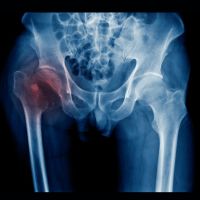 Deep Learning Model Predicts Subsequent Short-term Hip Fractures