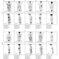 Deep Learning PET Imaging Model for Lymphoma Shows Clinical Potential