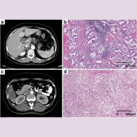 Prognostic Stratification for Liver Cancer Using CT Radiomics