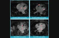 Performance of iNAV and dNAV Cardiac MRI Techniques for Atrial Fibrosis