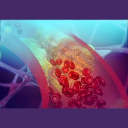 CT-FFR Analysis Lowers Invasive Procedures for Coronary Artery Disease Diagnosis CT-FFR Analysis Lowers Invasive Procedures for Coronary Artery Disease Diagnosis