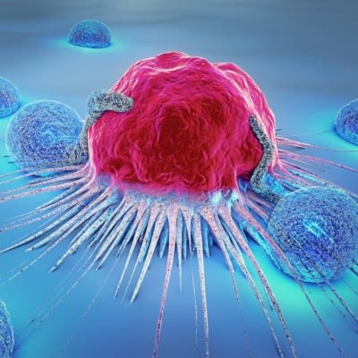 AI Predictive Tool Reinvents Post-Treatment Care for Breast Cancer Patients