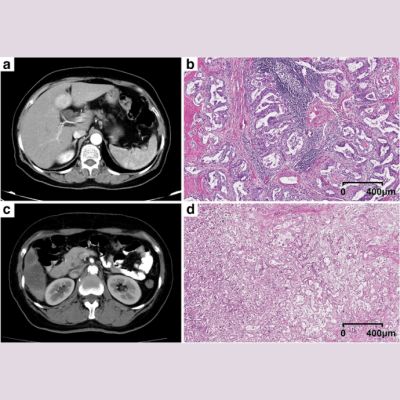 Prognostic Stratification for Liver Cancer Using CT Radiomics Prognostic Stratification for Liver Cancer Using CT Radiomics