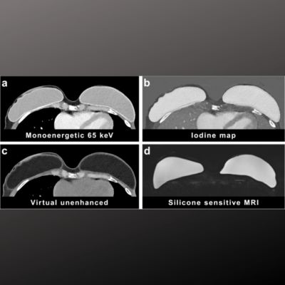 Assessing Silicone Breast Implants Ruptures with PCCT Assessing Silicone Breast Implants Ruptures with PCCT