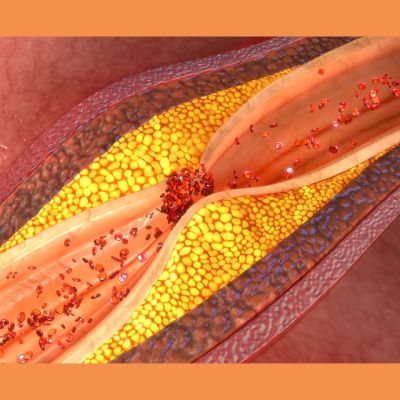 Prognostic Significance of CAD-RADS in Suspected Coronary Artery Disease