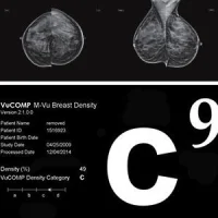 M-Vu&reg; Breast Density Software