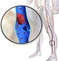 Deep vein thrombosis