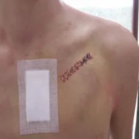 Pacemaker wound