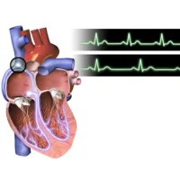 Bradycardia