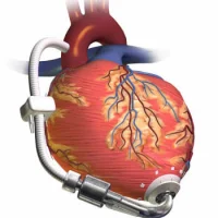 LVAD