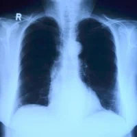 chest x-ray