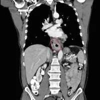 Osophageal cancer, CT scan with contrast, coronal image, credit Wikimedia Commons