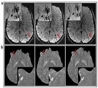 images showing the evolution of microhaemorrhages (arrows) 