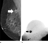 suspicious lesion (arrow) at screening mammography