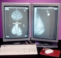 digital screening mammography