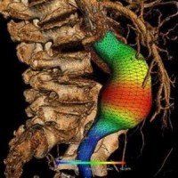 3D reconstruction of an abdominal aortic aneurysm