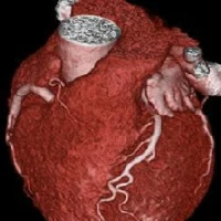 Cardiac CT without CAD