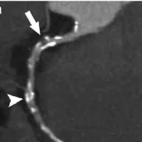 CT angiograms 