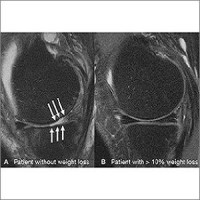 knee MRI scans