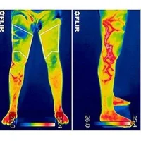 infrared thermography helps detect orthopaedic injury