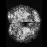 two mammograms of normal dense breasts