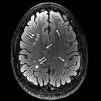 brain scan showing multiple white matter T2-weighted hyperintense areas (arrows)