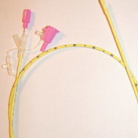 Nasogastric feeding tube