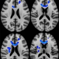 Blue indicates regions of the brain in which lower fractional anisotropy (FA - a measure of microstructural integrity) correlated with more severe neurobehavioral symptoms. Veterans with the most severe symptoms had lower FA in these regions. Source: Radi