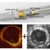 The dual catheter OCT-IVUS imaging device can be inserted into an artery to simultaneously capture an infrared image of the arterial wall (OCT, at left) and an ultrasound image (IVUS, right) that doctors use to determine the potential that a plaque is sus