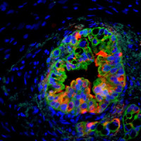 Expression of the stem cell gene Musashi in human pancreatic cancer. Cancer cells are shown in green, Musashi expression in red and blue includes cells within the cancer microenvironment. Image courtesy of Dawn Jaquish, UC San Diego.