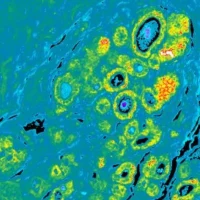 This image shows DCIS sample highlighting aggressive biomarkers. Credit: University of Michigan Health System