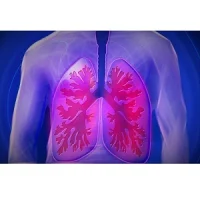 New Model Predicts Lung Cancer Risk in Light and Never Smokers 