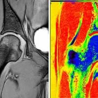 Raw image data collected from dGEMRIC MRI protocol at an inversion time of 1600 milliseconds (left). The T1 map computed from seven different inversion times using the automated, real-time, quantitative magnetic resonance imaging pipeline (right).