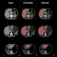 Segmentation of lesions in an organ using machine learning techniques, from a CT-scan image (left), performed by a convolutional neural network architecture (center) and manually (right).