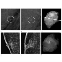 Screening Mammography for Men at Risk