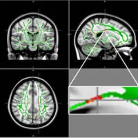 Reduction in fractional anisotrophy (FA) in obese patients compared to the control group.