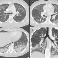  Chest CT angiographic images in a 24-year-old man with a history of e-cigarette use.