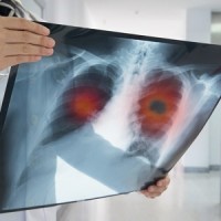 CT Lung Cancer Screening Reduces Deaths