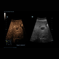 Expert Insights on HiFR-CEUS in Liver Diagnosis