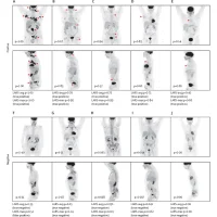 Deep Learning PET Imaging Model for Lymphoma Shows Clinical Potential