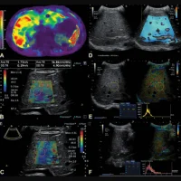 Assessing Liver Disease in Youth: A Comparative Study of Ultrasound and MRI Techniques