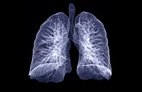 How to Better Manage Subsolid Lung Nodules?