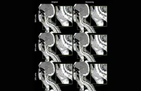 AI Denoising in Neck CT Imaging Enhances Diagnostic Accuracy