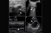 Multiorgan Ultrasound Reduces Diagnostic Imaging for Pulmonary Embolism