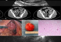 Imaging &amp; Histology in Retroperitoneal Benign Nerve Sheath Tumors