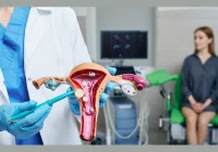 The Overlooked Option: Minimally Invasive Treatments for Uterine Fibroids