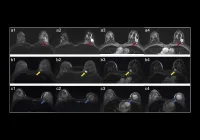 HER2 Status Prediction in Breast Cancer with MRI-Radiomics Model