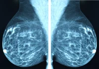 Impact of Digital Breast Tomosynthesis on Breast Cancer Detection